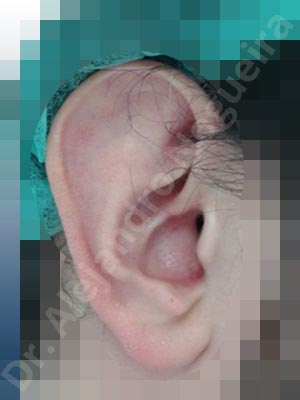 Orejas grandes,Orejas prominentes,Resección auricular cefálica en flor de lys