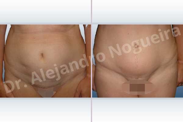 Abdomen descolgado,Cicatrices hundidas,Abdomen con debilidad muscular,Abdominoplastia estándar - photo 1