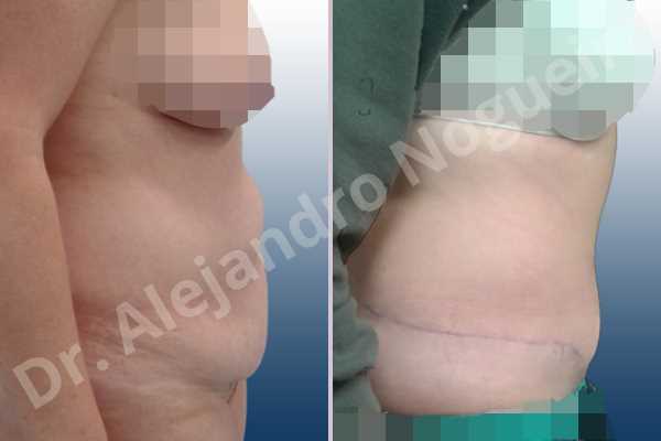 Abdomen descolgado,Abdomen con debilidad muscular,Abdominoplastia estándar - photo 4