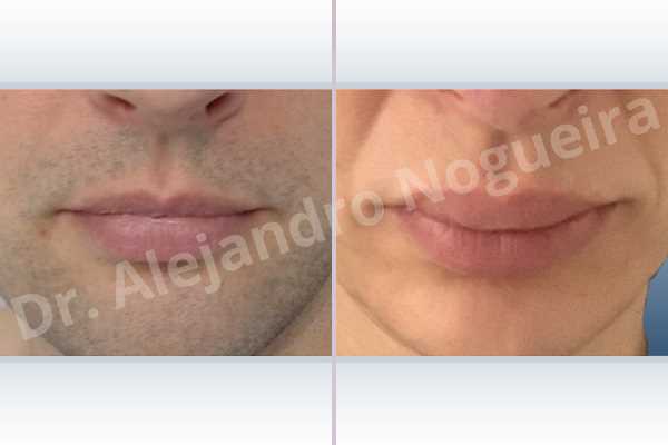 Labios pequeños,Labios transgénero,Relleno con colágeno dérmico autólogo de labio superior - photo 1