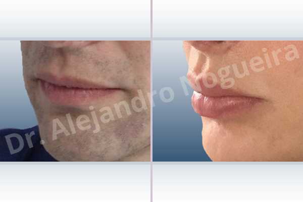Labios pequeños,Labios transgénero,Relleno con colágeno dérmico autólogo de labio superior - photo 4