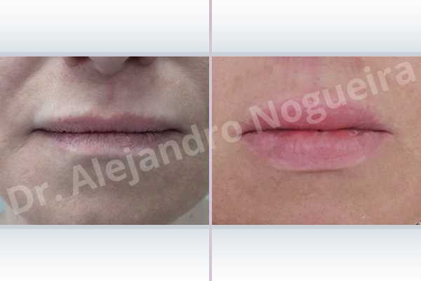 Labios pequeños,Relleno con colágeno dérmico autólogo de labio inferior,Relleno con colágeno dérmico autólogo de labio superior - photo 1