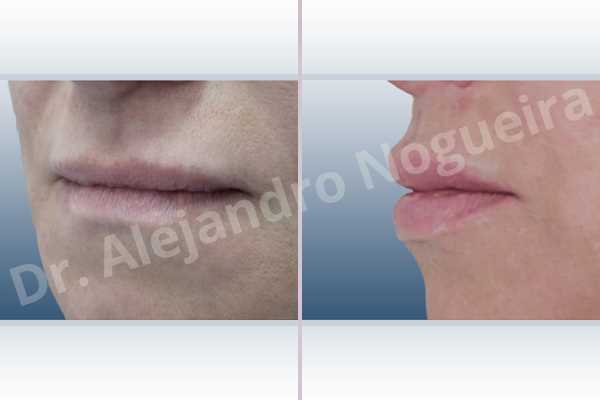 Labios pequeños,Relleno con colágeno dérmico autólogo de labio inferior,Relleno con colágeno dérmico autólogo de labio superior - photo 3
