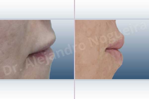 Labios pequeños,Relleno con colágeno dérmico autólogo de labio inferior,Relleno con colágeno dérmico autólogo de labio superior - photo 4