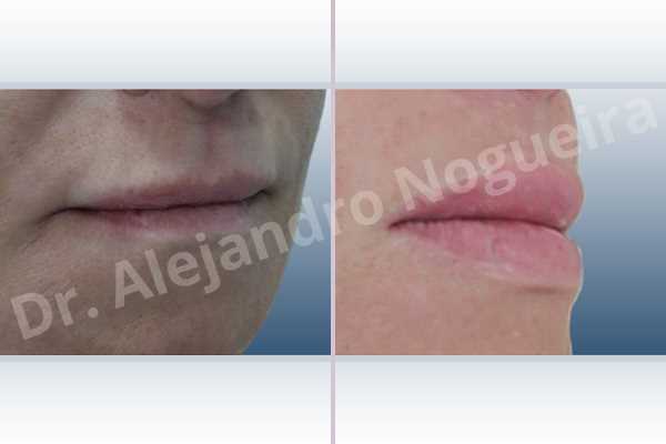 Labios pequeños,Relleno con colágeno dérmico autólogo de labio inferior,Relleno con colágeno dérmico autólogo de labio superior - photo 5