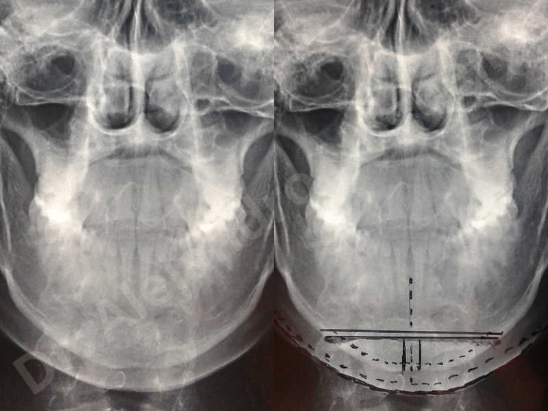 Mentón grande,Mentón transgénero,Osteotomía horizontal de mentón,Resección ósea horizontal de mentón,Genioplastia bidimensional,Resección ósea vertical de mentón - photo 3