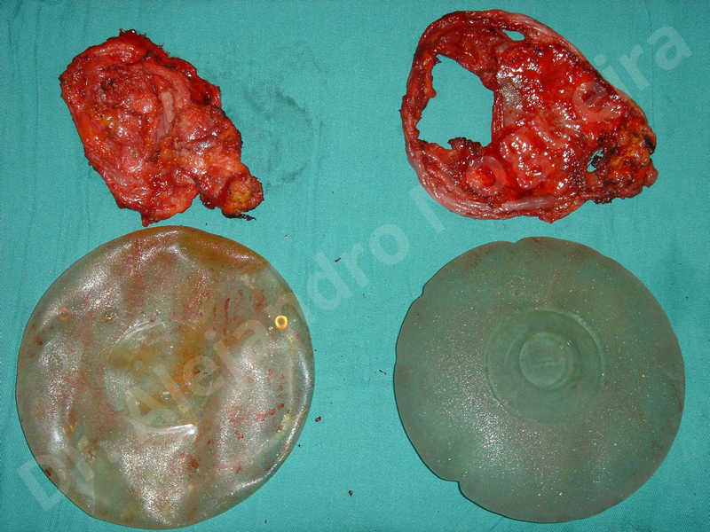 Pechos asimétricos,Implantes mamarios rotos,Pechos vacíos,Implantes mamarios demasiado estrechos,Capsulectomía - photo 2