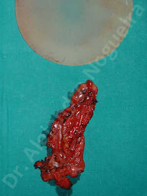 Contractura capsular de implantes mamarios,Pechos asimétricos,Pechos vacíos,Implantes mamarios demasiado estrechos,Capsulectomía