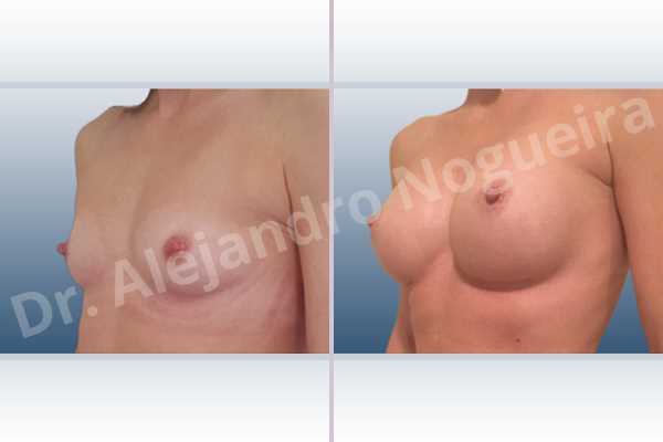Asymmetric breasts,Empty breasts,Narrow breasts,Skinny breasts,Small breasts,Anatomical shape,Lower hemi periareolar incision,Subfascial pocket plane - photo 3