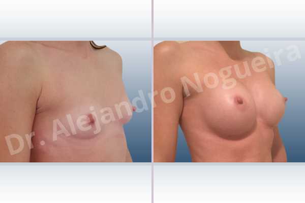 Asymmetric breasts,Empty breasts,Narrow breasts,Skinny breasts,Small breasts,Anatomical shape,Lower hemi periareolar incision,Subfascial pocket plane - photo 5