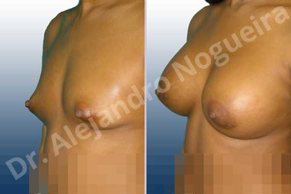 Asymmetric breasts,Cross eyed breasts,Narrow breasts,Small breasts,Tuberous breasts,Lower hemi periareolar incision,Round shape,Subfascial pocket plane,Tuberous mammoplasty - photo 3