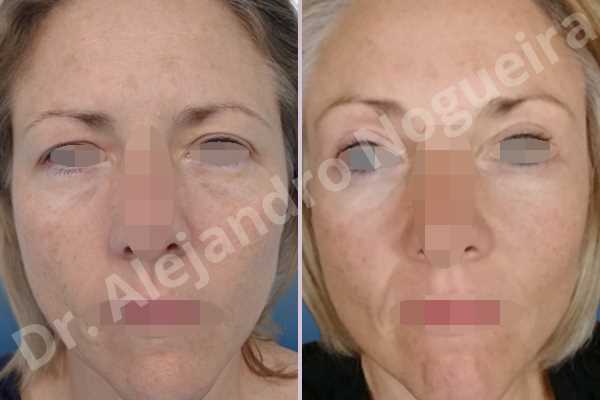 Deep nasolabial folds,Droopy cheeks,Droopy eyebrows,Droopy face,Droopy forehead,Saggy upper eyelids,Short temporal incisions supraperiosteal extended lift of the upper two thirds of the face,Upper eyelid skin and muscle resection - photo 1