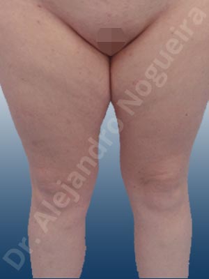 Thigh gap flab,Tumescent liposuction