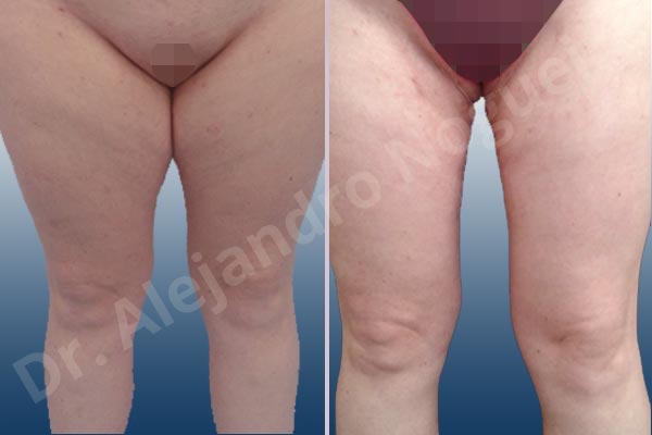 Thigh gap flab,Tumescent liposuction - photo 1