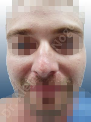 Alar flaring,Broad nose,Central European nose,Dorsum hump,Dorsum ridges,Droopy tip,Dynamic alar flaring,Jewish nose,Long upper lateral cartilages,Plunging tip deformity,Rhomboid dorsum,Thick skin nose,Closed approach incision,Dorsum hump resection,Lateral cruras cephalic resection,Medial cruras shortening resection,Nasal bones osteotomies,Triangular cartilages caudal resection