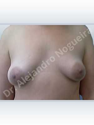 Asymmetric breasts,Empty breasts,Large areolas,Lateral breasts,Mildly saggy droopy breasts,Pigeon chest,Slightly saggy droopy breasts,Small breasts,Too far apart wide cleavage breasts,Tuberous breasts,Wide breasts,Anatomical shape,Areola reduction,Circumareolar incision,Subfascial pocket plane,Tuberous mammoplasty