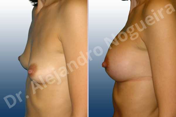 Asymmetric breasts,Cross eyed breasts,Empty breasts,Narrow breasts,Skinny breasts,Slightly saggy droopy breasts,Small breasts,Anatomical shape,Lower hemi periareolar incision,Subfascial pocket plane - photo 2