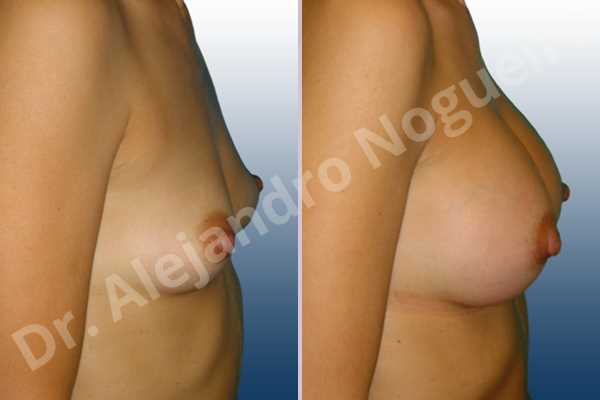 Asymmetric breasts,Cross eyed breasts,Empty breasts,Narrow breasts,Skinny breasts,Slightly saggy droopy breasts,Small breasts,Anatomical shape,Lower hemi periareolar incision,Subfascial pocket plane - photo 4