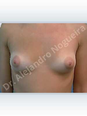 Lateral breasts,Small breasts,Tuberous breasts,Cross eyed breasts,Anatomical shape,Lower hemi periareolar incision,Subfascial pocket plane,Tuberous mammoplasty