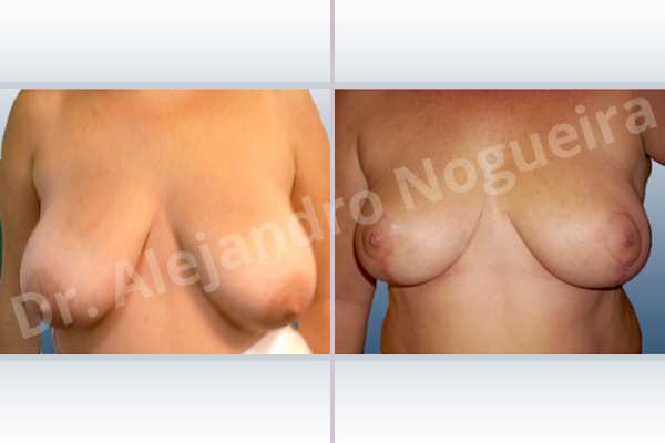 Extremely saggy droopy breasts,Large areolas,Lateral breasts,Moderately large breasts,Pendulous breasts,Severely large breasts,Severely saggy droopy breasts,Tuberous breasts,Anchor incision,Double vertical pedicle - photo 1