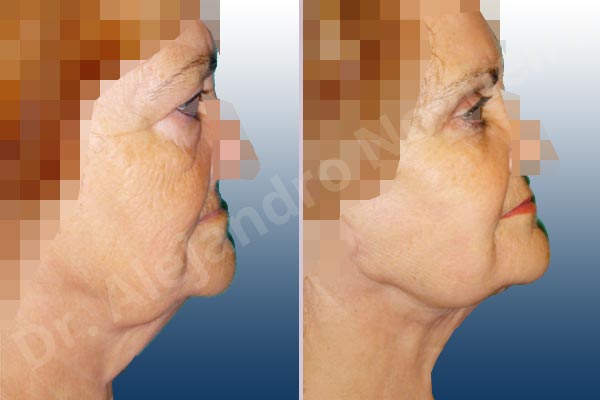 Baggy lower eyelids,Baggy upper eyelids,Deep nasolabial folds,Double chin flab,Droopy cheeks,Droopy face,Saggy jowls,Saggy neck,Saggy upper eyelids,Deep plane SMAS platysma face and neck lift,Lower eyelid fat bags resection,Transconjunctival approach incision,Upper eyelid fat bags resection,Upper eyelid skin and muscle resection - photo 4