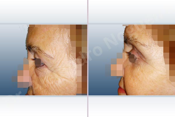 Baggy lower eyelids,Baggy upper eyelids,Deep nasolabial folds,Double chin flab,Droopy cheeks,Droopy face,Saggy jowls,Saggy neck,Saggy upper eyelids,Deep plane SMAS platysma face and neck lift,Lower eyelid fat bags resection,Transconjunctival approach incision,Upper eyelid fat bags resection,Upper eyelid skin and muscle resection - photo 7