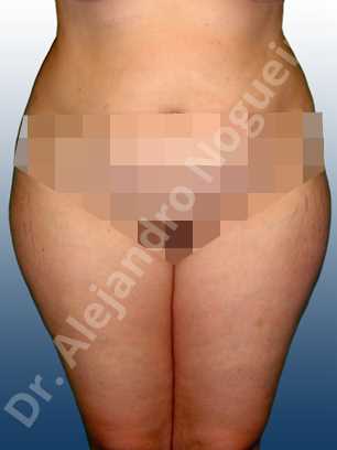 Saddle bags flab,Thigh gap flab,Tumescent liposuction