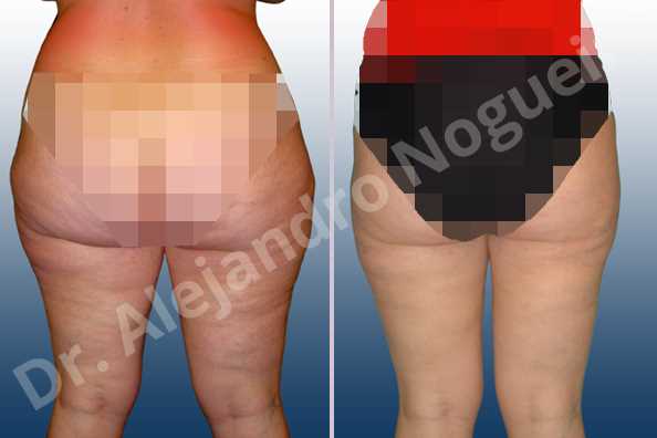 Saddle bags flab,Thigh gap flab,Tumescent liposuction - photo 2