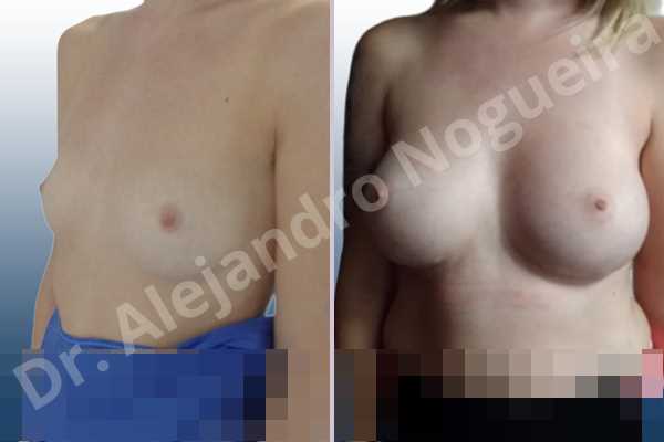 Asymmetric breasts,Cross eyed breasts,Empty breasts,Lateral breasts,Skinny breasts,Small breasts,Too far apart wide cleavage breasts,Wide breasts,Anatomical shape,Inframammary incision,Subfascial pocket plane - photo 3
