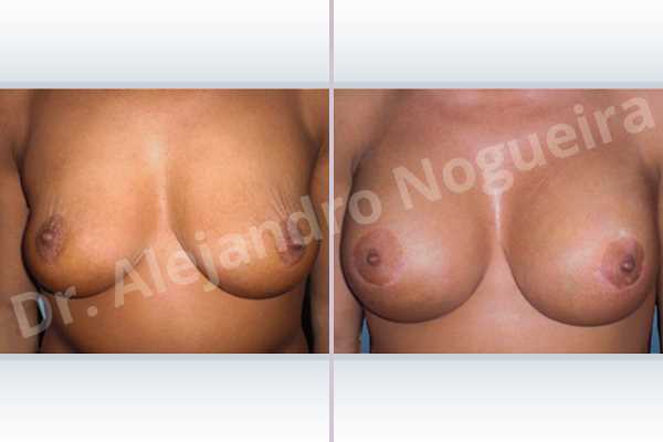 Asymmetric breasts,Breast tissue bottoming out,Cross eyed breasts,Empty breasts,Failed breast reduction,Pendulous breasts,Slightly saggy droopy breasts,Small breasts,Wide breasts,Anatomical shape,Anchor incision,Extra large size,Lower hemi periareolar incision,Subfascial pocket plane - photo 1