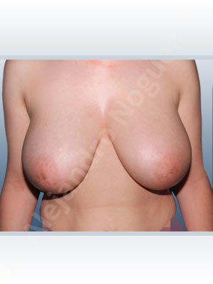 Breast tissues symmastia uniboob,Moderately large breasts,Severely saggy droopy breasts,Tuberous breasts,Anchor incision,Superior pedicle