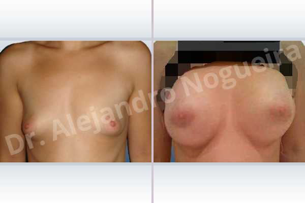 Asymmetric breasts,Narrow breasts,Pigeon chest,Skinny breasts,Small breasts,Too far apart wide cleavage breasts,Tuberous breasts,Anatomical shape,Lower hemi periareolar incision,Subfascial pocket plane,Tuberous mammoplasty - photo 1