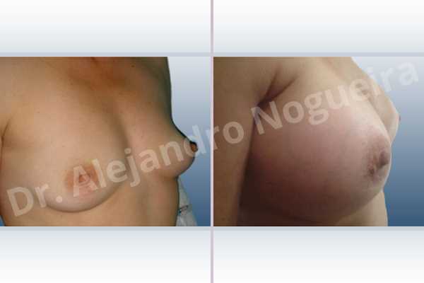 Empty breasts,Lateral breasts,Slightly saggy droopy breasts,Small breasts,Too far apart wide cleavage breasts,Anatomical shape,Extra large size,Lower hemi periareolar incision,Subfascial pocket plane - photo 2
