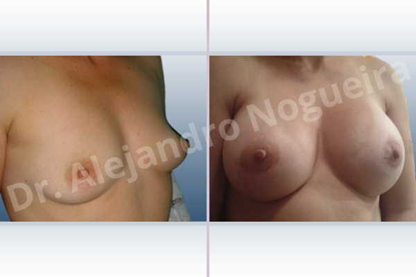 Empty breasts,Lateral breasts,Slightly saggy droopy breasts,Small breasts,Too far apart wide cleavage breasts,Anatomical shape,Extra large size,Lower hemi periareolar incision,Subfascial pocket plane - photo 3