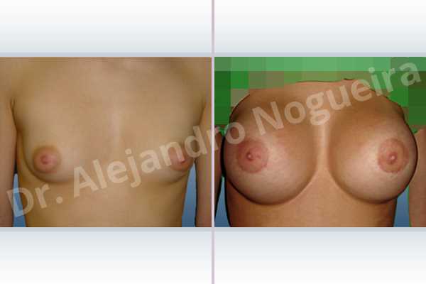 Asymmetric breasts,Cross eyed breasts,Lateral breasts,Small breasts,Too far apart wide cleavage breasts,Tuberous breasts,Lower hemi periareolar incision,Round shape,Subfascial pocket plane,Tuberous mammoplasty - photo 1