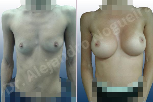 Asymmetric breasts,Cross eyed breasts,Empty breasts,Narrow breasts,Pigeon chest,Skinny breasts,Slightly saggy droopy breasts,Small breasts,Too far apart wide cleavage breasts,Anatomical shape,Inframammary incision,Subfascial pocket plane - photo 1