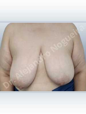 Asymmetric breasts,Breast tissue bottoming out,Breast tissues symmastia uniboob,Empty breasts,Extremely saggy droopy breasts,Large areolas,Pendulous breasts,Severely large breasts,Too far apart wide cleavage breasts,Wide breasts,Tuberous breasts,Anatomical shape,Anchor incision,Areola reduction,Double vertical pedicle,Subfascial pocket plane