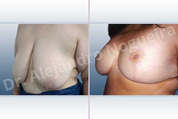 Asymmetric breasts,Breast tissue bottoming out,Breast tissues symmastia uniboob,Empty breasts,Extremely saggy droopy breasts,Large areolas,Pendulous breasts,Severely large breasts,Too far apart wide cleavage breasts,Wide breasts,Tuberous breasts,Anatomical shape,Anchor incision,Areola reduction,Double vertical pedicle,Subfascial pocket plane - photo 3