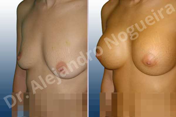 Asymmetric breasts,Empty breasts,Lateral breasts,Mildly saggy droopy breasts,Skinny breasts,Slightly saggy droopy breasts,Small breasts,Sunken chest,Too far apart wide cleavage breasts,Lower hemi periareolar incision,Round shape,Subfascial pocket plane - photo 3