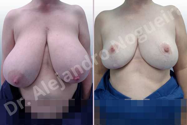 Asymmetric breasts,Breast tissue bottoming out,Extremely large breasts,Extremely saggy droopy breasts,Large areolas,Lateral breasts,Pendulous breasts,Pigeon chest,Wide breasts,Tuberous breasts,Anchor incision,Areola reduction,Double vertical pedicle - photo 1