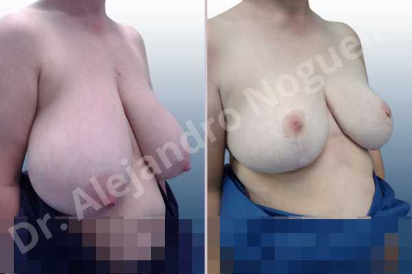 Asymmetric breasts,Breast tissue bottoming out,Extremely large breasts,Extremely saggy droopy breasts,Large areolas,Lateral breasts,Pendulous breasts,Pigeon chest,Wide breasts,Tuberous breasts,Anchor incision,Areola reduction,Double vertical pedicle - photo 5