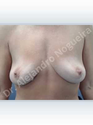 Asymmetric breasts,Cross eyed breasts,Empty breasts,Lateral breasts,Moderately saggy droopy breasts,Pendulous breasts,Pigeon chest,Skinny breasts,Small breasts,Too far apart wide cleavage breasts,Wide breasts,Anatomical shape,Extra large size,Lower hemi periareolar incision,Subfascial pocket plane