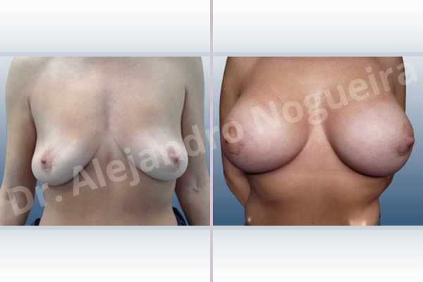 Asymmetric breasts,Cross eyed breasts,Empty breasts,Lateral breasts,Moderately saggy droopy breasts,Pendulous breasts,Pigeon chest,Skinny breasts,Small breasts,Too far apart wide cleavage breasts,Wide breasts,Anatomical shape,Extra large size,Lower hemi periareolar incision,Subfascial pocket plane - photo 1