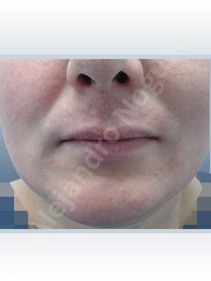 Small lips,Transgender lips,Lower lip autologous dermis collagen filler