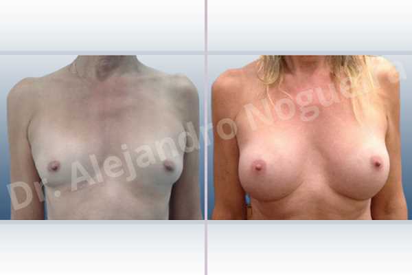 Asymmetric breasts,Cross eyed breasts,Empty breasts,Lateral breasts,Skinny breasts,Small breasts,Sunken chest,Too far apart wide cleavage breasts,Transgender breasts,Wide breasts,Anatomical shape,Inframammary incision,Subfascial pocket plane - photo 1
