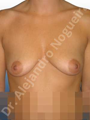 Empty breasts,Mildly saggy droopy breasts,Moderately saggy droopy breasts,Small breasts,Too far apart wide cleavage breasts,Tuberous breasts,Anatomical shape,Lower hemi periareolar incision,Subfascial pocket plane,Tuberous mammoplasty