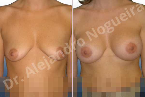 Empty breasts,Mildly saggy droopy breasts,Moderately saggy droopy breasts,Small breasts,Too far apart wide cleavage breasts,Tuberous breasts,Anatomical shape,Lower hemi periareolar incision,Subfascial pocket plane,Tuberous mammoplasty - photo 1