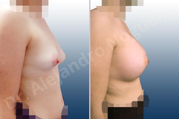 Asymmetric breasts,Cross eyed breasts,Empty breasts,Large areolas,Lateral breasts,Slightly saggy droopy breasts,Small breasts,Too far apart wide cleavage breasts,Tuberous breasts,Wide breasts,Anatomical shape,Lower hemi periareolar incision,Subfascial pocket plane,Tuberous mammoplasty - photo 4