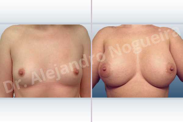 Asymmetric breasts,Lateral breasts,Small breasts,Too far apart wide cleavage breasts,Anatomical shape,Extra large size,Lower hemi periareolar incision,Subfascial pocket plane - photo 1