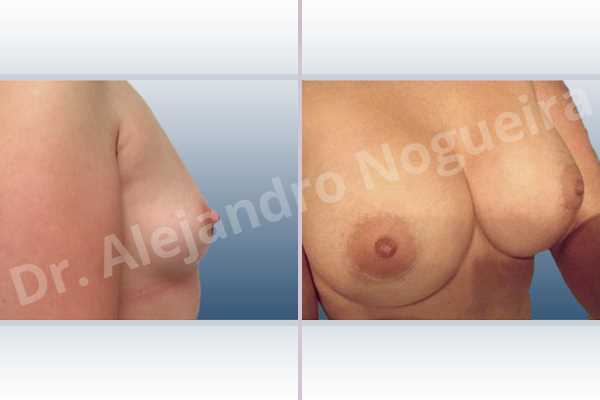 Asymmetric breasts,Lateral breasts,Small breasts,Too far apart wide cleavage breasts,Anatomical shape,Extra large size,Lower hemi periareolar incision,Subfascial pocket plane - photo 4